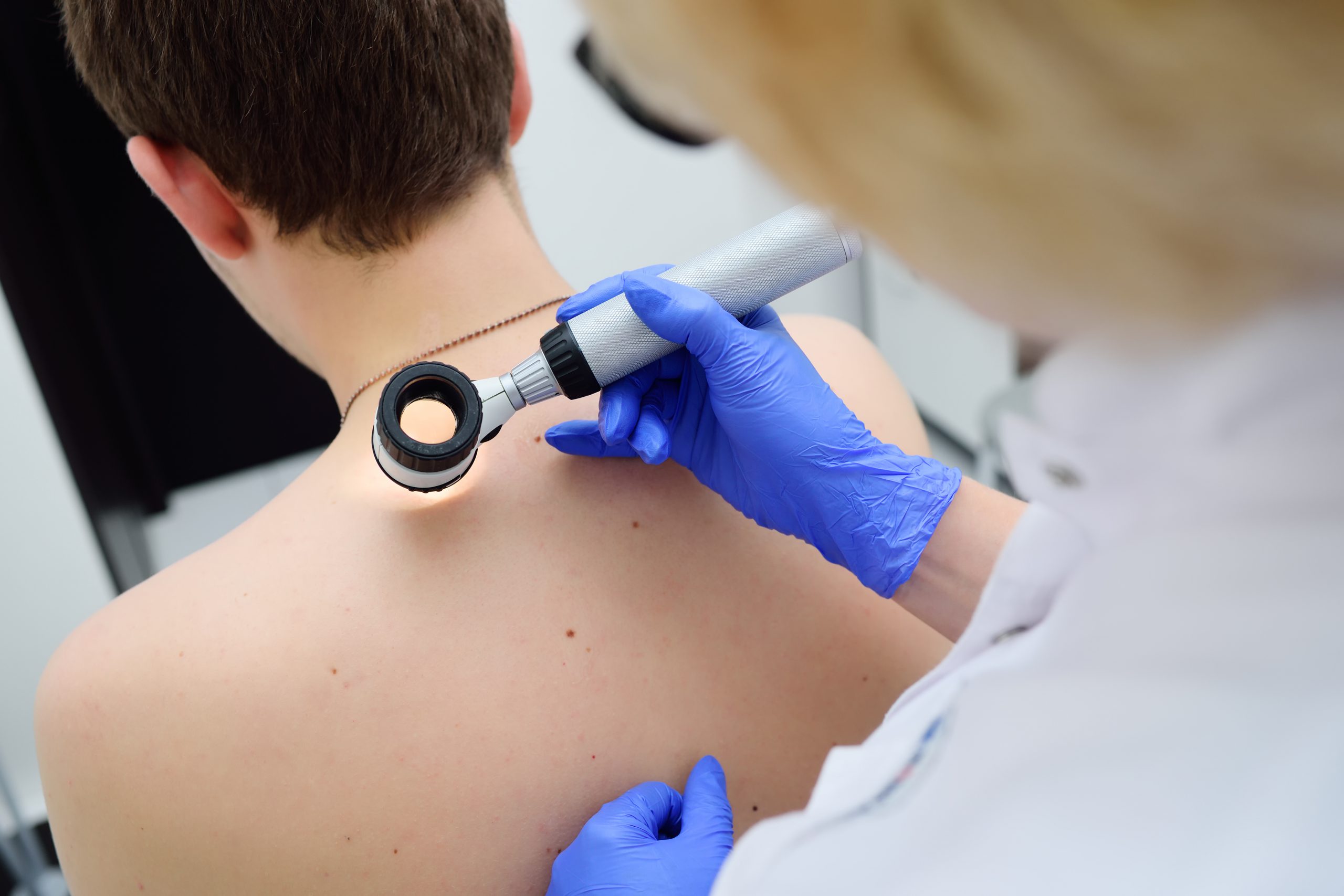 Co to jest dermatoskopia i kiedy warto ją wykonać?