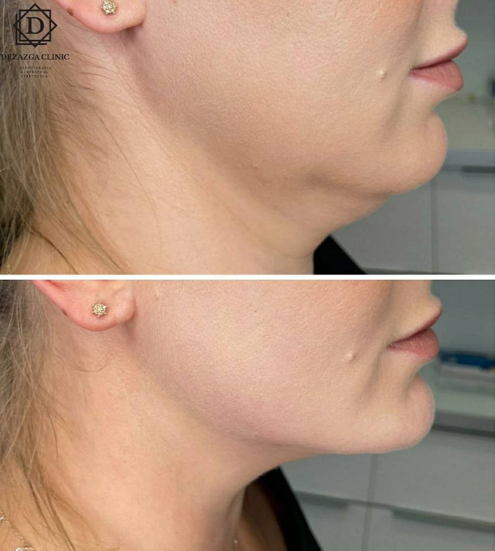 Kobieta przed i po wolumetrii twarzy